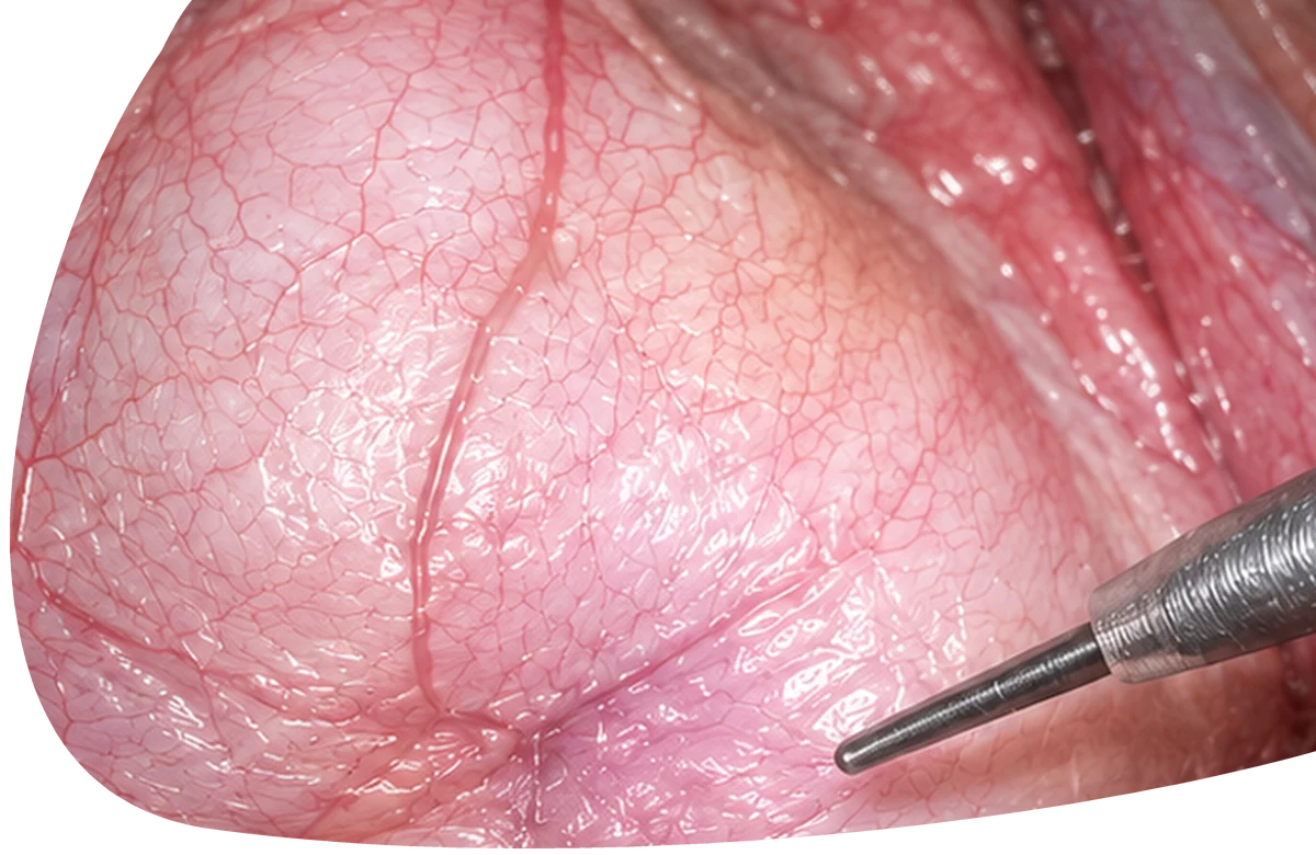 Illustrative surgical image used to introduce S-Vixta image enhancement