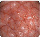 Endoscopy image illustrating limited fine-detail visibility