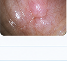 Endoscopy image illustrating haze and image noise