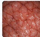 Endoscopy image illustrating improved detail visibility