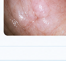 Endoscopy image illustrating a clearer display in challenging conditions